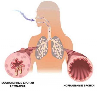 Эксперты: похудение может помочь астматикам