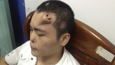 Хирурги из Китая смогли вырастить на лбу пациента новый нос