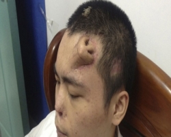 Хирурги из Китая смогли вырастить на лбу пациента новый нос